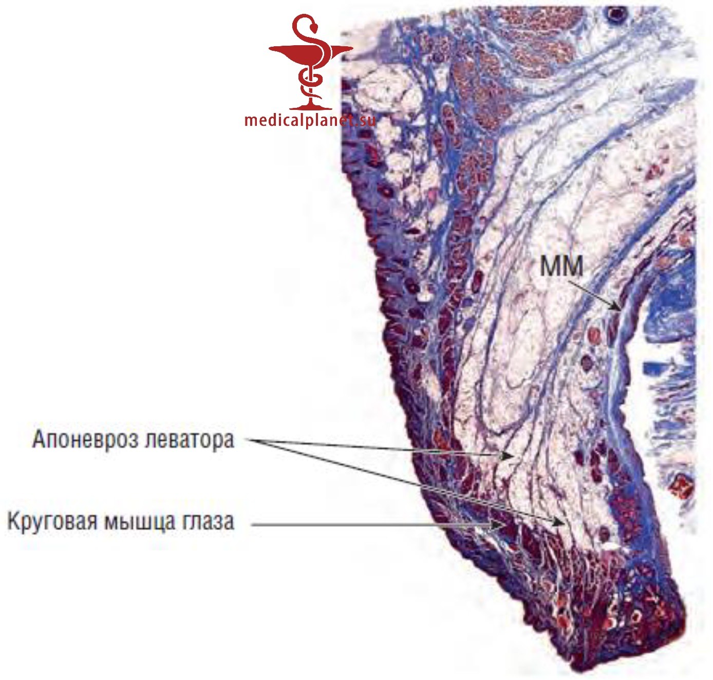Нюансы создания борозды верхнего века при азиатской (ориентальной) блефаропластике