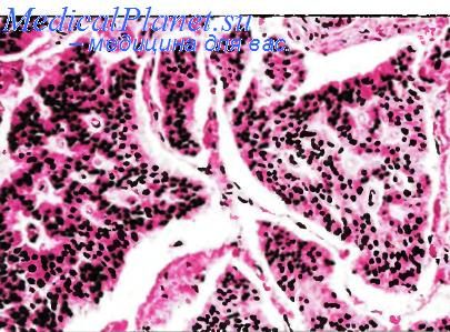 Опухолью D-клеток (соматоститинома) толстой кишки.