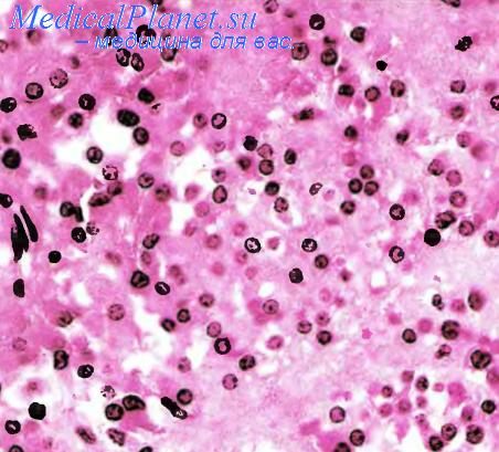 Стероидно-клеточная опухоль яичников