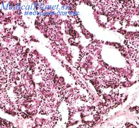 Переходно-клеточный рак мочевого пузыря