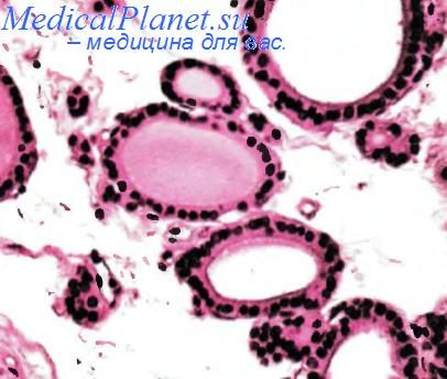 Эмбриональная аденома щитовидной железы из А-клеток.