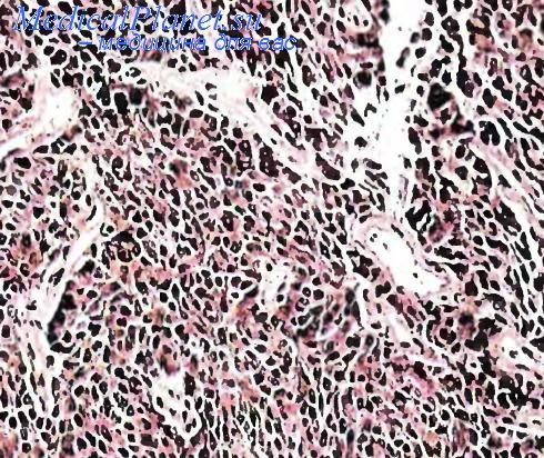 Доброкачественная опухоль щитовидной железы из С-клеток.