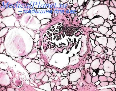 Папиллярный рак щитовидной железы из А-клеток