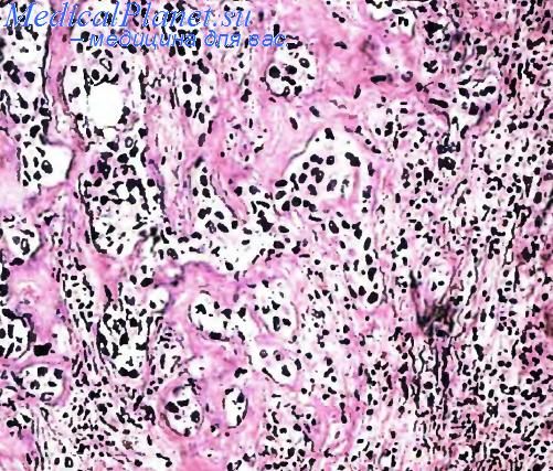 Плоскоклеточный рак щитовидной железы