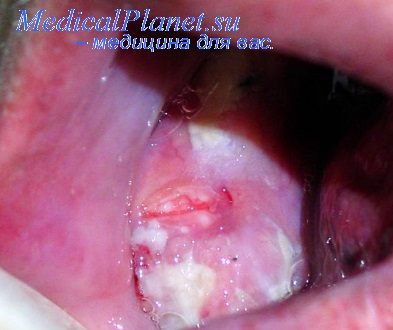 рак слизистой рта