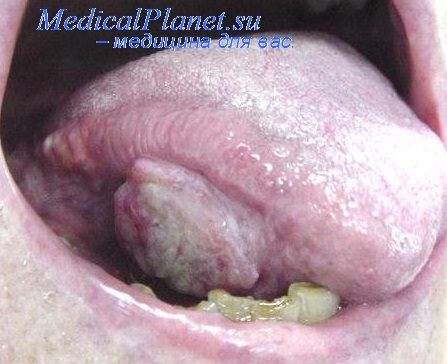 рак слизистой рта