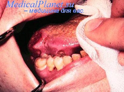 рак дна полости рта
