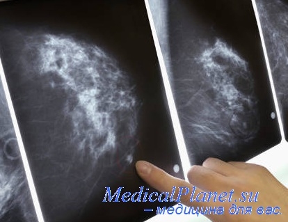 Связь рака желудка с раком молочной железы thumbnail