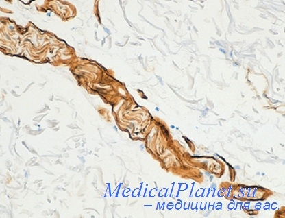 базальная мембрана опухоли