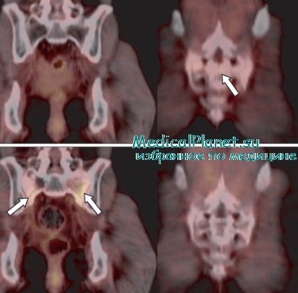позитронно-эмиссионная томография при раке шейки матки