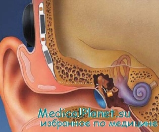 тимпанопластика с трансплантацией слуховых косточек