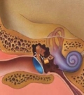 трансплантация слуховых косточек