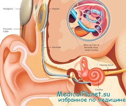 нарушения слуха при интоксикациях