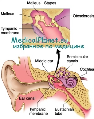 глухота при инфекционной болезни