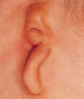пороки развития уха