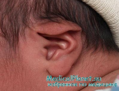 развитие детей с пороками органа слуха
