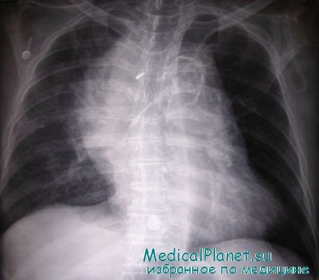 рентгенография при травме груди