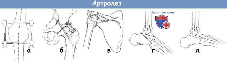 Артродез суставов операция