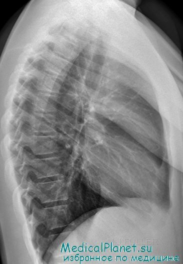 Рентгенограмма грудного отдела позвоночника