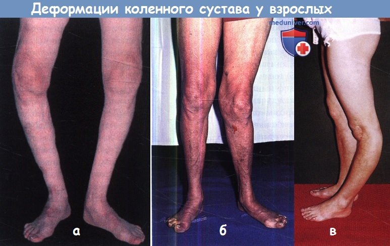 Деформации коленного сустава у взрослых