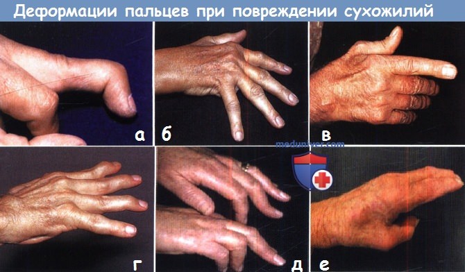 Деформации пальцев кисти при повреждении сухожилий