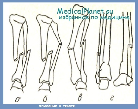 Виды диафизарных переломов обеих костей голени - механизмы