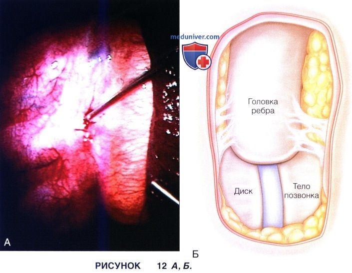Доступ, техника операции эндоскопической дискэктомии грудного отдела позвоночника