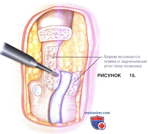Доступ, техника операции эндоскопической дискэктомии грудного отдела позвоночника