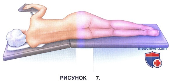 Показания, укладка пациента при эндоскопической дискэктомии грудного отдела позвоночника