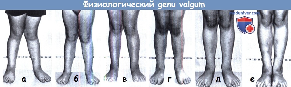 Физиологическое искривление коленных суставов - genu valgum