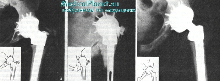 Нагноение после операции тазобедренного сустава thumbnail