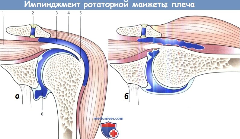 Импинджмент ротаторной манжеты плеча