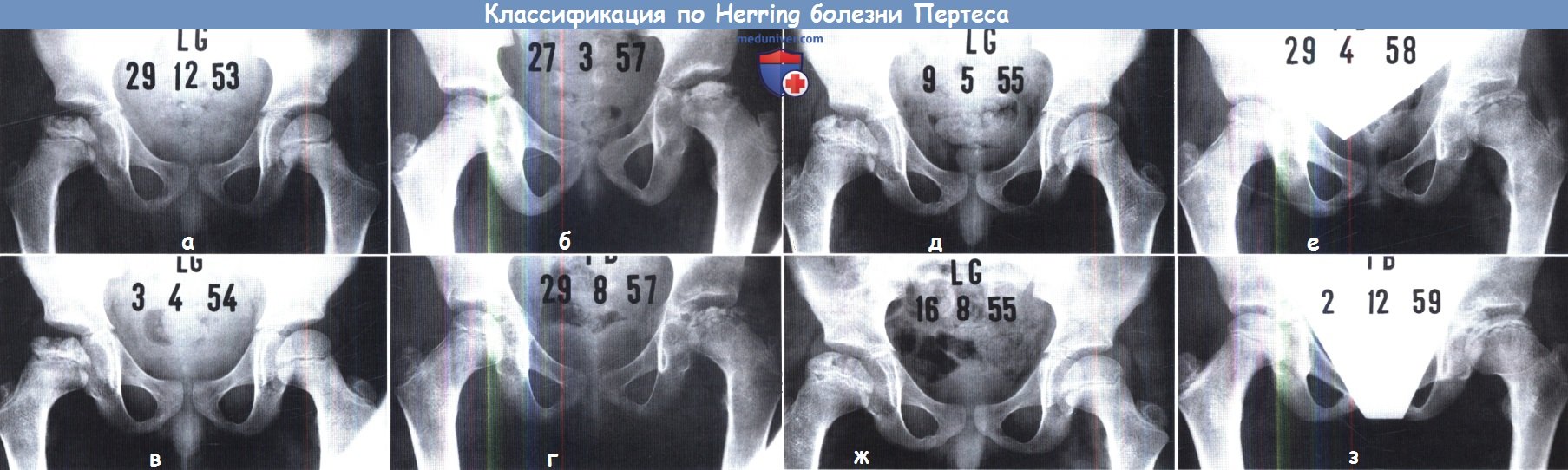 Классификация по Herring болезни Пертеса