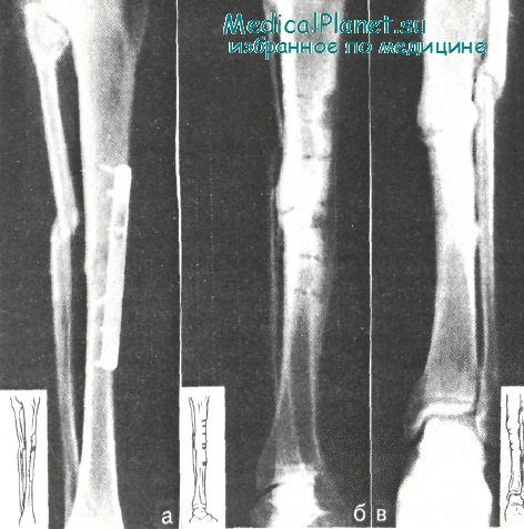 Лечение свища при переломах ноги thumbnail
