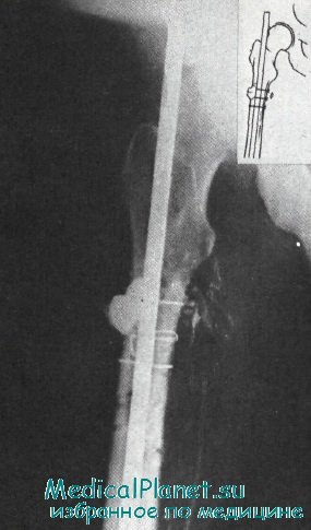 Свищ после операции перелома кости thumbnail