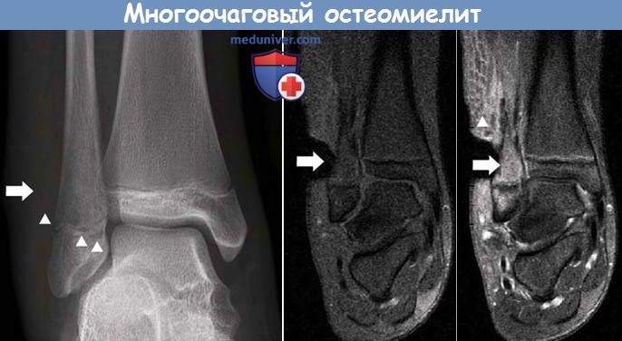 Рентгенография при многоочаговом негнойном остеомиелите