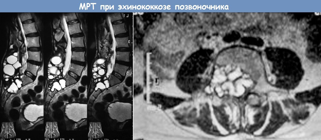 МРТ при эхинококкозе позвоночника
