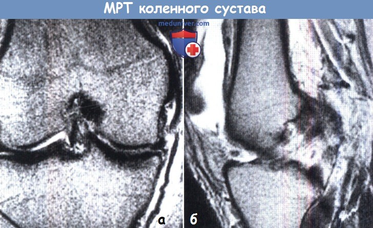 МРТ коленного сустава