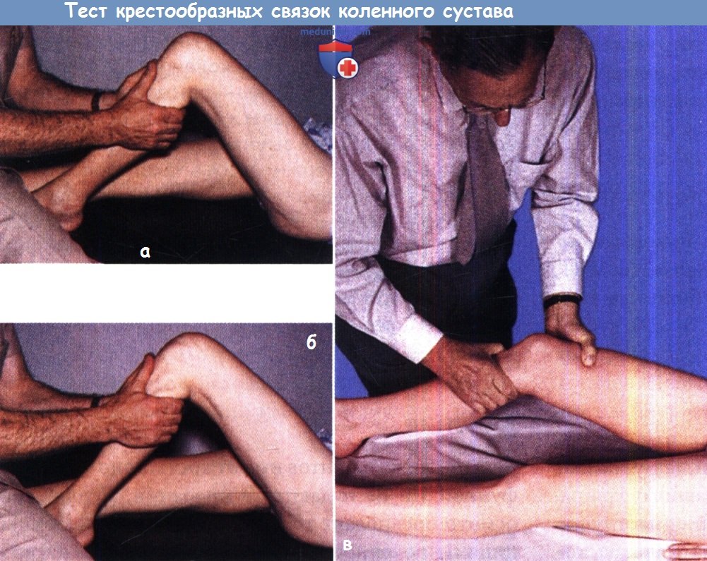 Оценка крестообразных связок коленного сустава