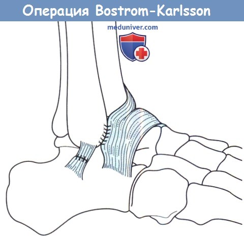 Операция Bostrom-Karlsson