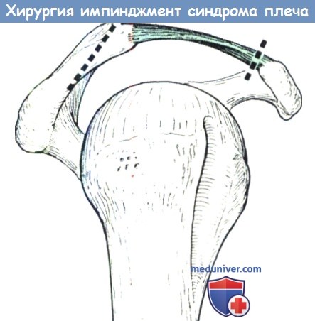 Операция при импиджмент синдроме плеча