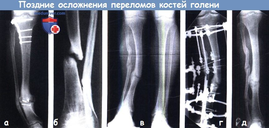 Осложнения при переломе костей голени thumbnail