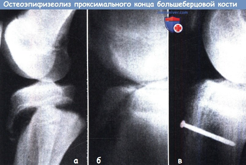 Остеоэпифизеолиз проксимального конца большеберцовой кости