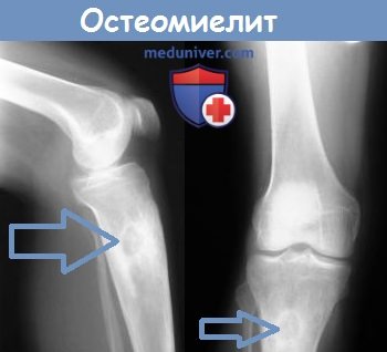 Рентгеновский снимок при остеомиелите большеберцовой кости