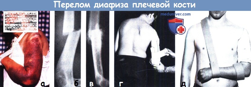 Перелом диафиза плечевой кости