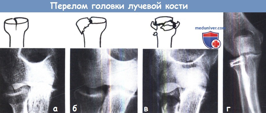 Перелом головки лучевой кости без смещения фото