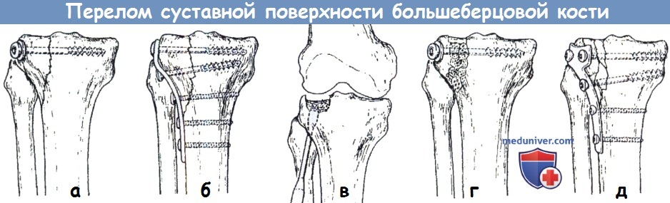 Лечение перелома суставной поверхности большеберцовой кости