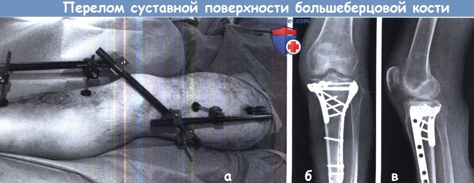 Лечение перелома суставной поверхности большеберцовой кости