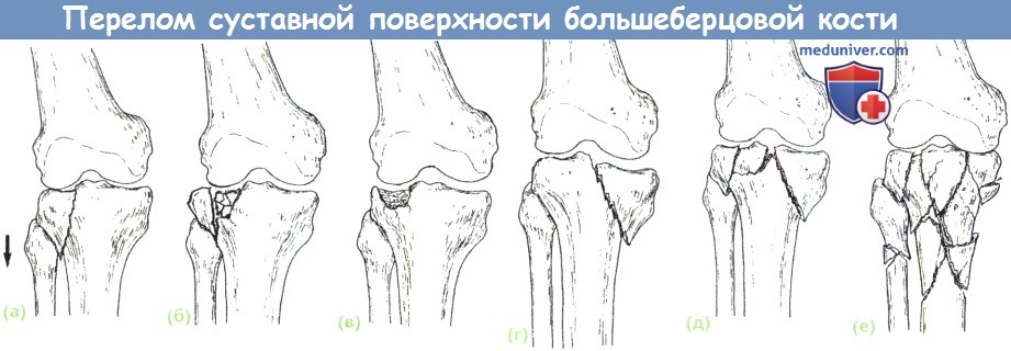 Перелом суставной поверхности большеберцовой кости