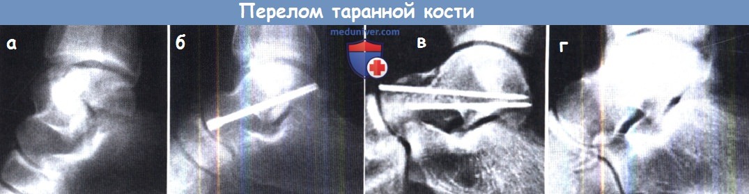 Перелом заднего отростка таранной кости без смещения. Перелом таранной кости рентген.